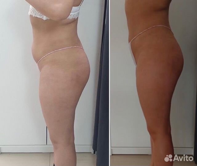 Глубокий антицеллюлитный Субдермальный массаж