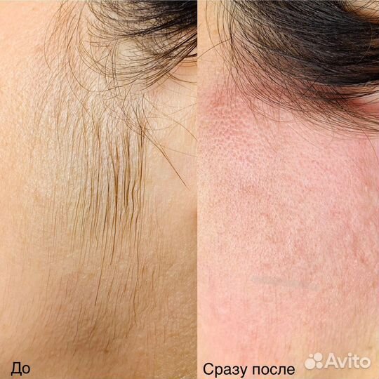 Электроэпиляция