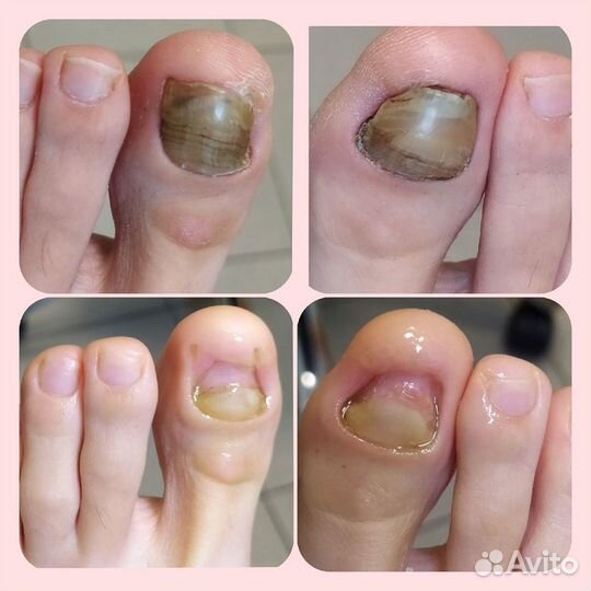 Травма ногтя. Подолог СПб