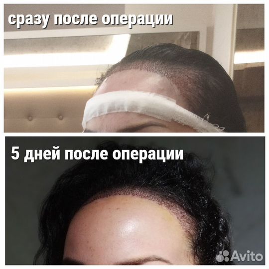 Пересадка волос в Турции