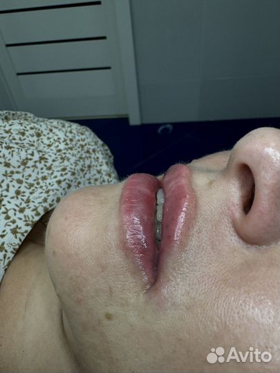 Контурная пластика губ