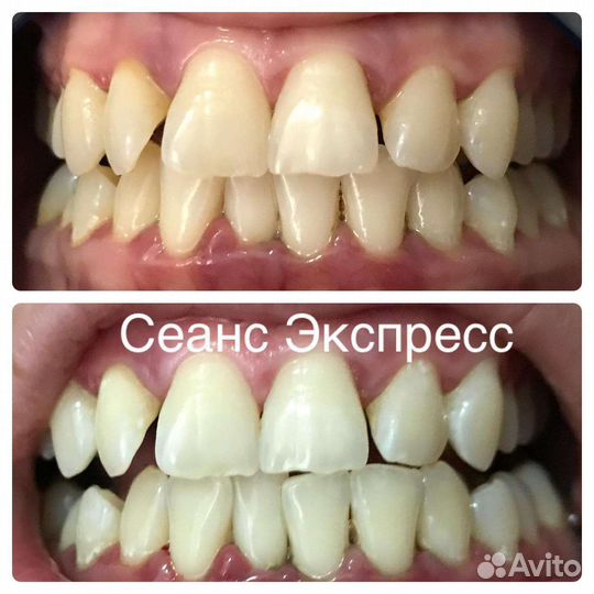 Белоснежные зубы