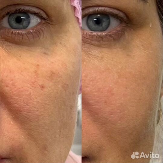 Плазмолифтинг