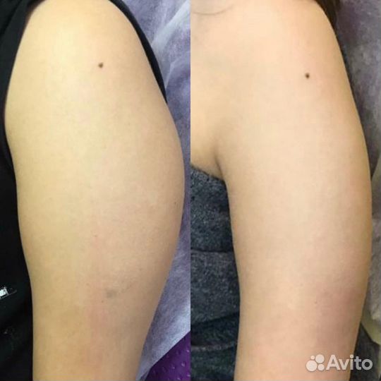 Липолитики, худое лицо, стройное тело, жиротоп