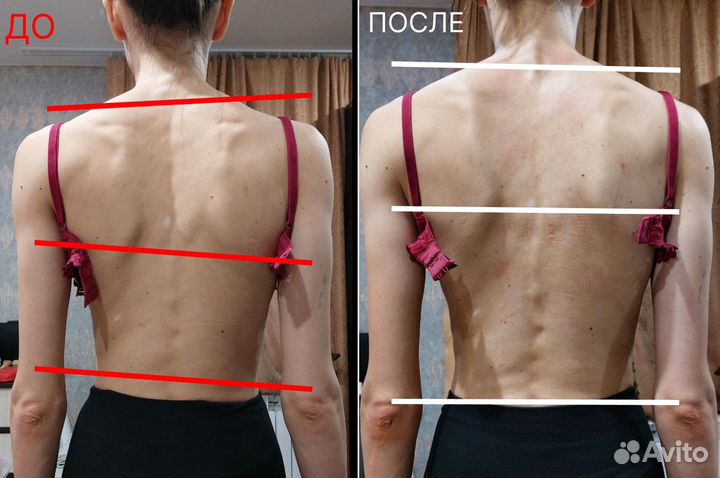 Мануальщик вправление позвонков без боли Ю