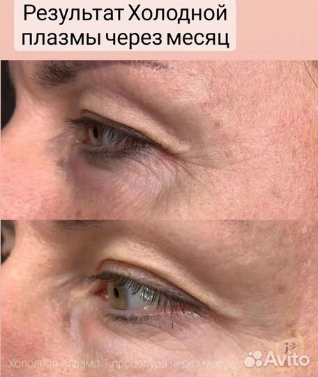 Холодная плазма