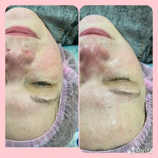 Массаж, вакуум, кавитация