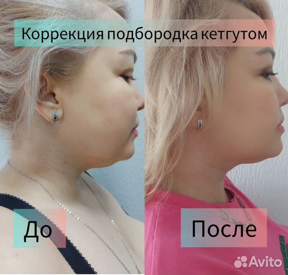 Кетгут терапия, похудение, подтяжка фигуры