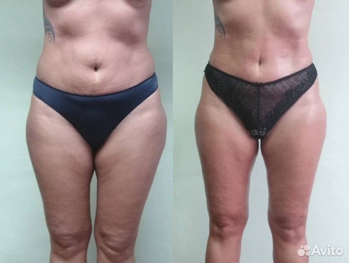 Антицеллюлитный массаж