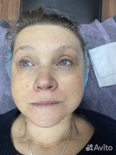 Буккальный массаж