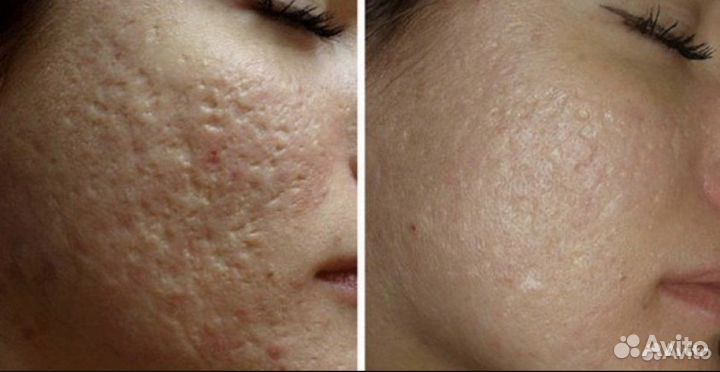 Крем Smart 27, от псориаза экземы аллергии