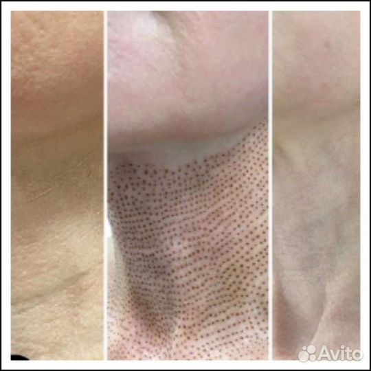 Мультиплазменное омоложение кожи