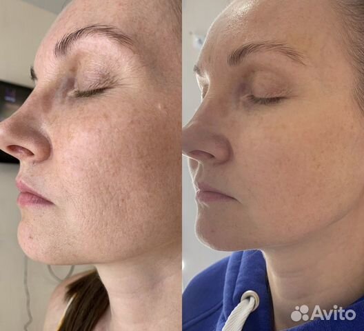 Smas лифтинг лица(подтяжка)