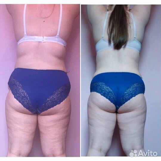 Массаж LPG и Шугаринг