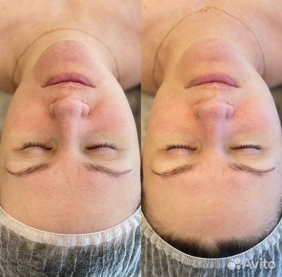 Карбокситерапия