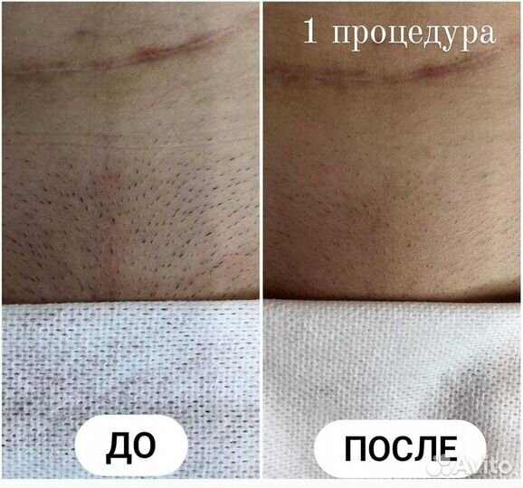 Лазерная эпиляция всего тела