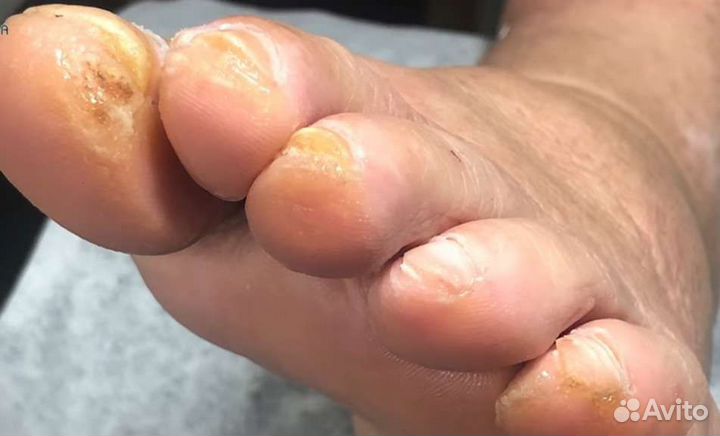 Педикюр для пожилых с выездом на дом