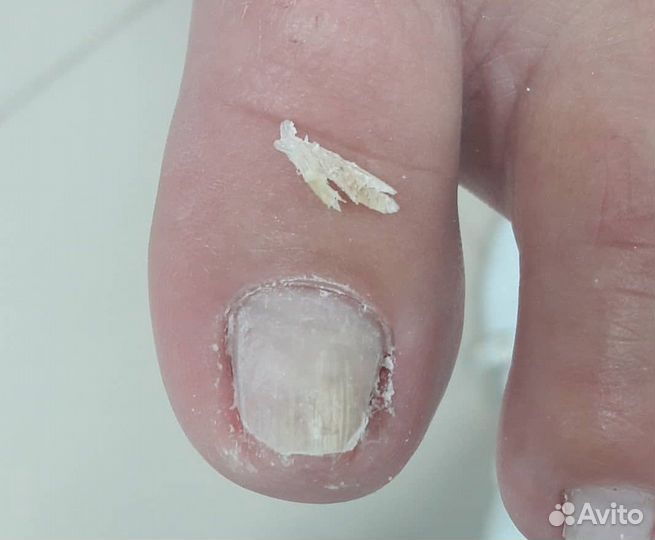 Медицинский педикюр вросший ноготь