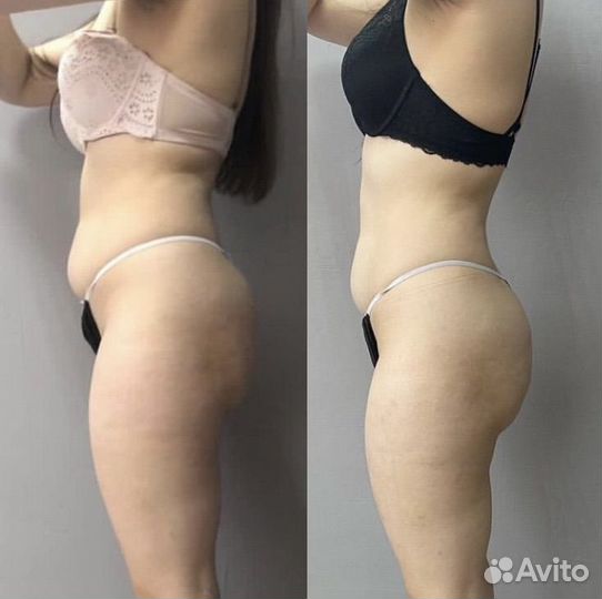 Вакуумный массаж Турбомассаж коррекция фигуры