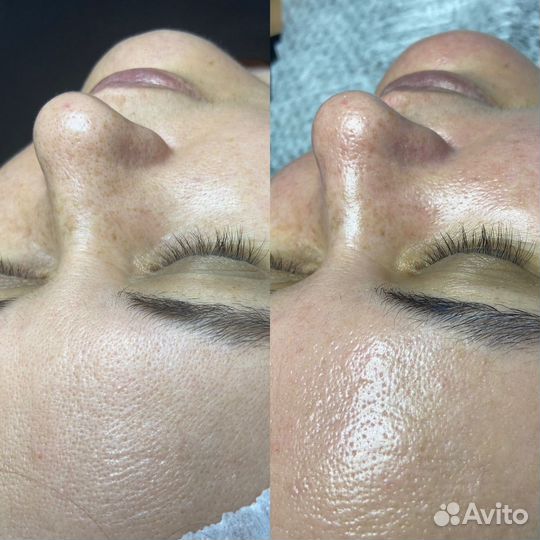 Чистка лица