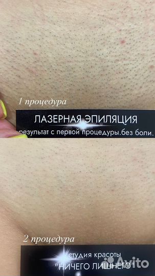 Лазерная эпиляция