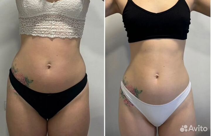 LPG массаж в Перми Оригинальный бразильский LPG