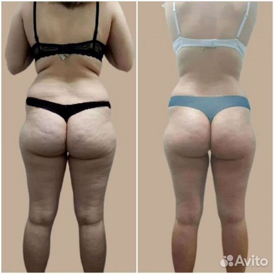 LPG массаж на самом мощном аппарате