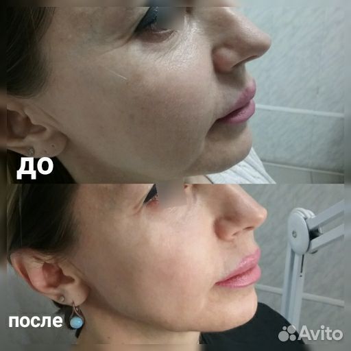 Холодная плазма, Импульсная спрей-коагуляция кожи