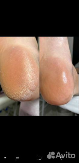 Педикюр дисками