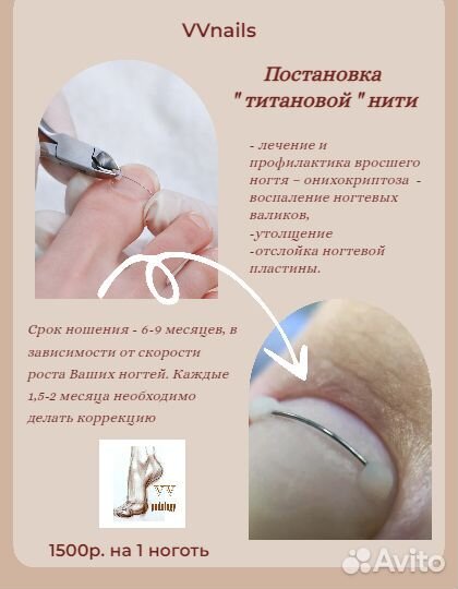 Лечебный педикюр подолог