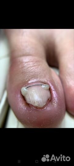 Подолог,вросший ноготь, стержневые мозоли