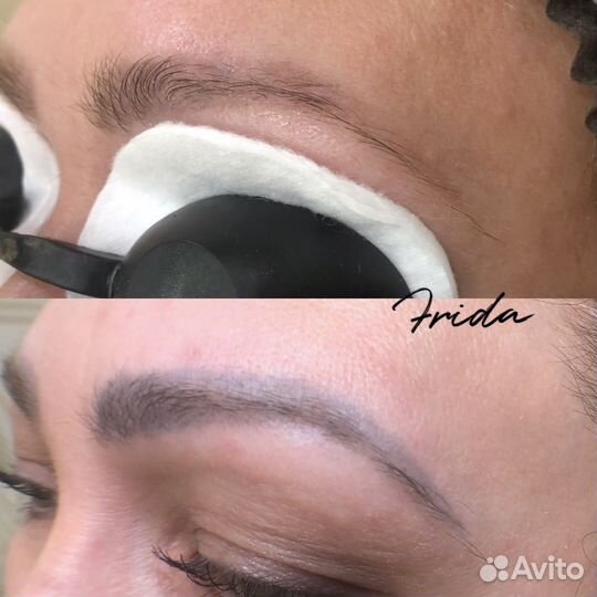 Лазерное удаление татуажа и татуировок