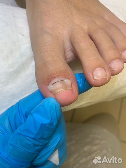 Подология, мозоли, трещины, вросшие ногти