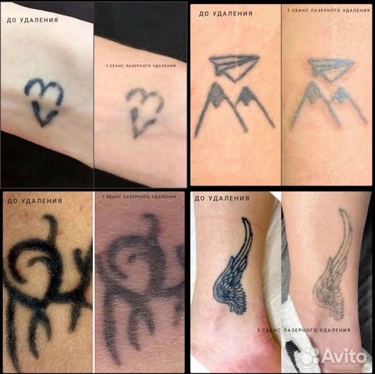 Удаление & Карбоновый пилинг спб