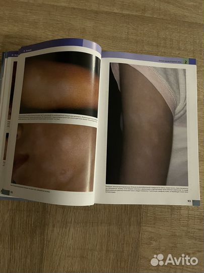 Кожные болезни. Хэбиф