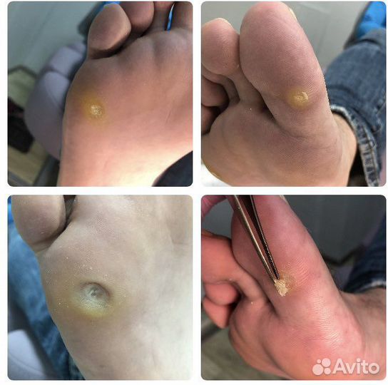 Подолог, педикюр