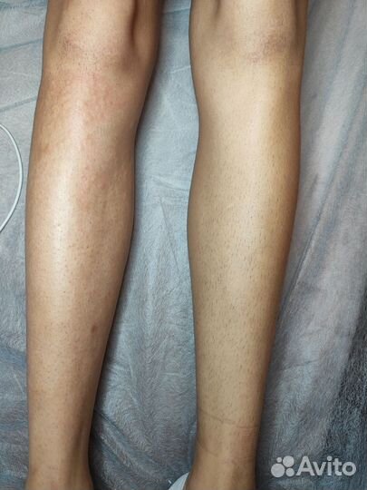 Электроэпиляция