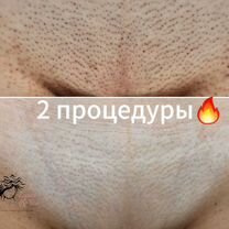 Лазерная эпиляция, Санкт-Петербург