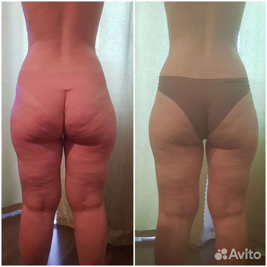 Антицеллюлитный массаж, коррекция фигуры