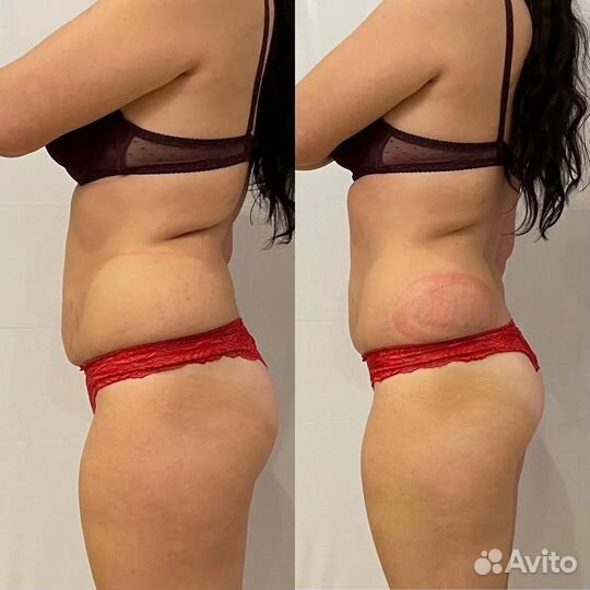 Криолиполиз