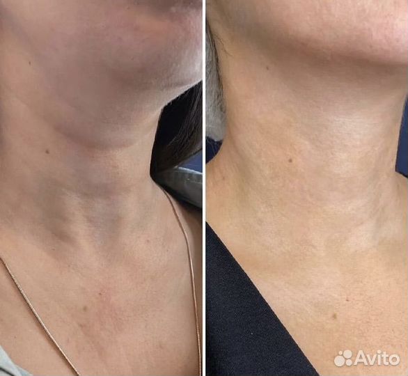 RF лифтинг morpheus 8