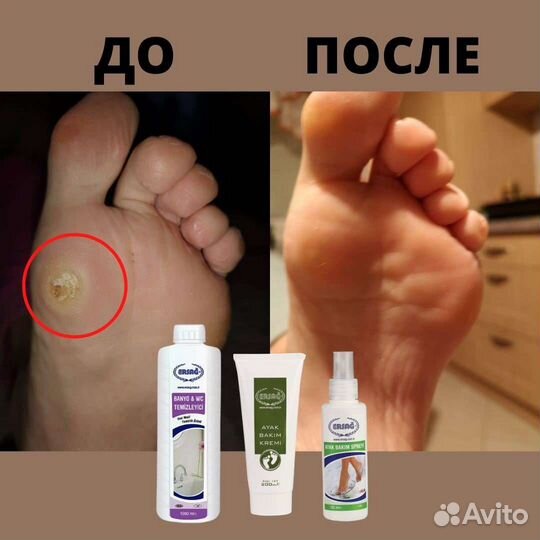 Натоптыши,гладкие пятки