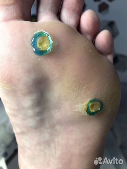 Мастер педикюра/сложные стопы/трещины/мозоли