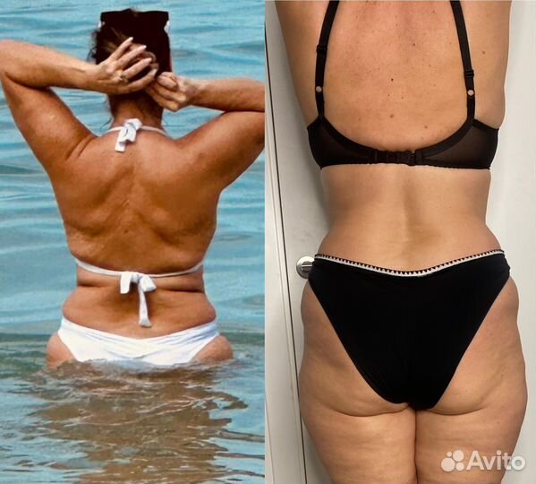 Аппаратный массаж