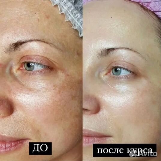 Косметолог/ Холодная плазма