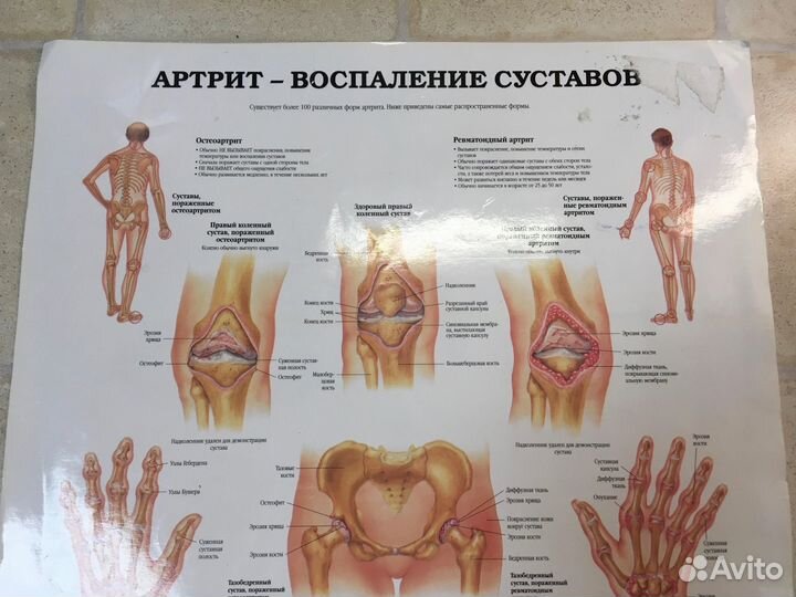 Плакат медицинский артрит 2 стороны