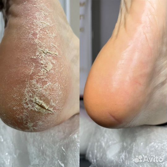 Медицинский педикюр подолог