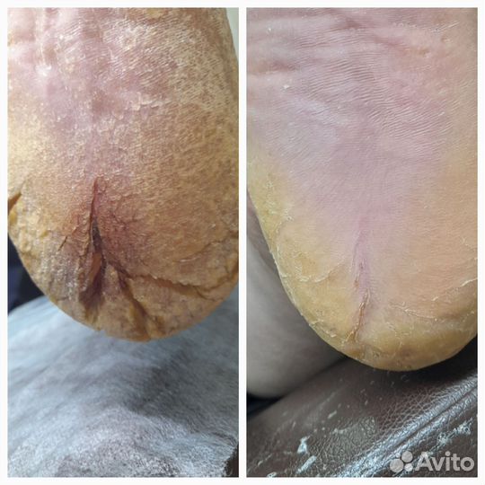 Коррекция вросшего ногтя