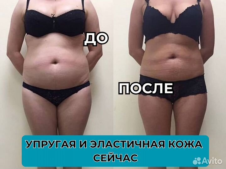 Аппаратный массаж / Массаж лпг / LPG