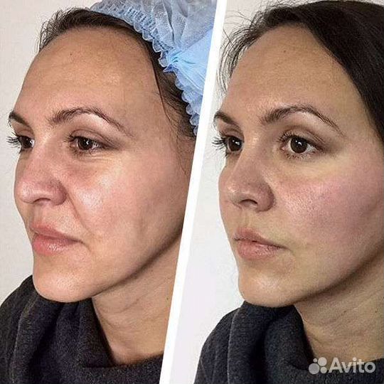 Косметология, контурная пластика